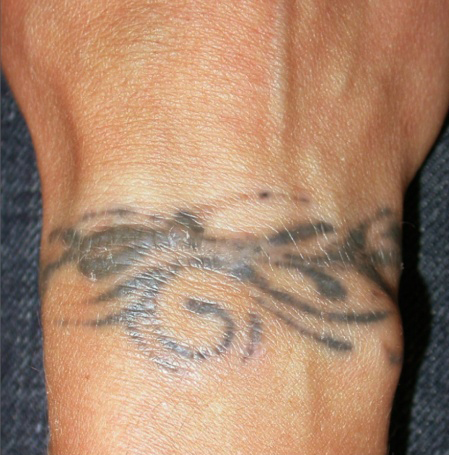 Bild före behandling - Remove Tattoos