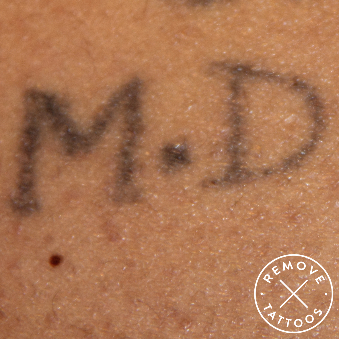 Bild före behandling - Remove Tattoos